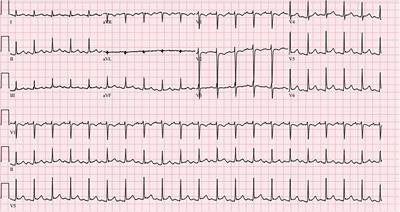 Case Report: Three cases of clinically suspected viral myocarditis with recovery of left ventricular dysfunction